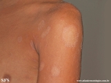 pityriasis rosea