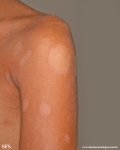 pityriasis rosea