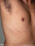 pityriasis rosea