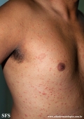 pityriasis rosea