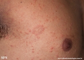 pityriasis rosea