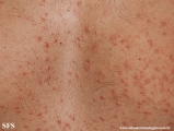 pityriasis rosea