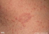 pityriasis rosea