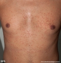 pityriasis rosea