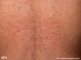 pityriasis rosea