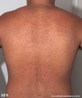 pityriasis rosea