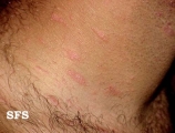 pityriasis rosea