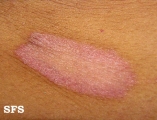 pityriasis rosea