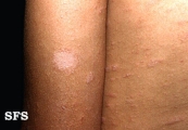 pityriasis rosea