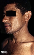 pityriasis rosea