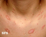 pityriasis rosea