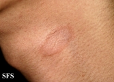 pityriasis rosea