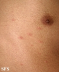 pityriasis rosea