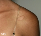 pityriasis rosea