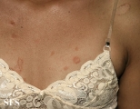 pityriasis rosea
