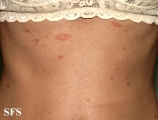 pityriasis rosea