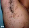 pityriasis rosea