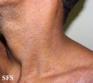 pityriasis rosea