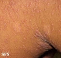 pityriasis rosea