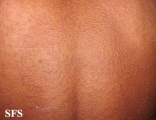 pityriasis rosea