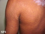 pityriasis rosea