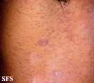 pityriasis rosea