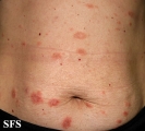 pityriasis rosea