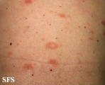 pityriasis rosea