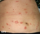 pityriasis rosea