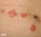 pityriasis rosea