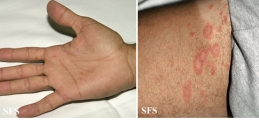 pityriasis rosea