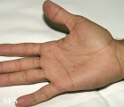 pityriasis rosea