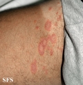 pityriasis rosea