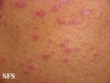 pityriasis rosea