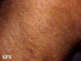 pityriasis rosea