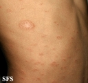 pityriasis rosea
