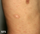 pityriasis rosea