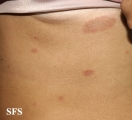 pityriasis rosea