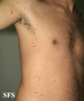 pityriasis rosea