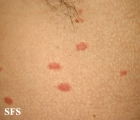 pityriasis rosea