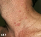 pityriasis rosea
