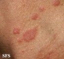 pityriasis rosea