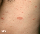 pityriasis rosea
