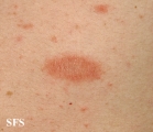 pityriasis rosea