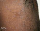 pityriasis rosea