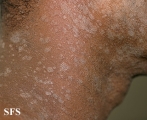 pityriasis rosea