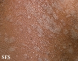 pityriasis rosea