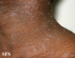 pityriasis rosea