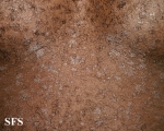 pityriasis rosea