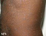 pityriasis rosea